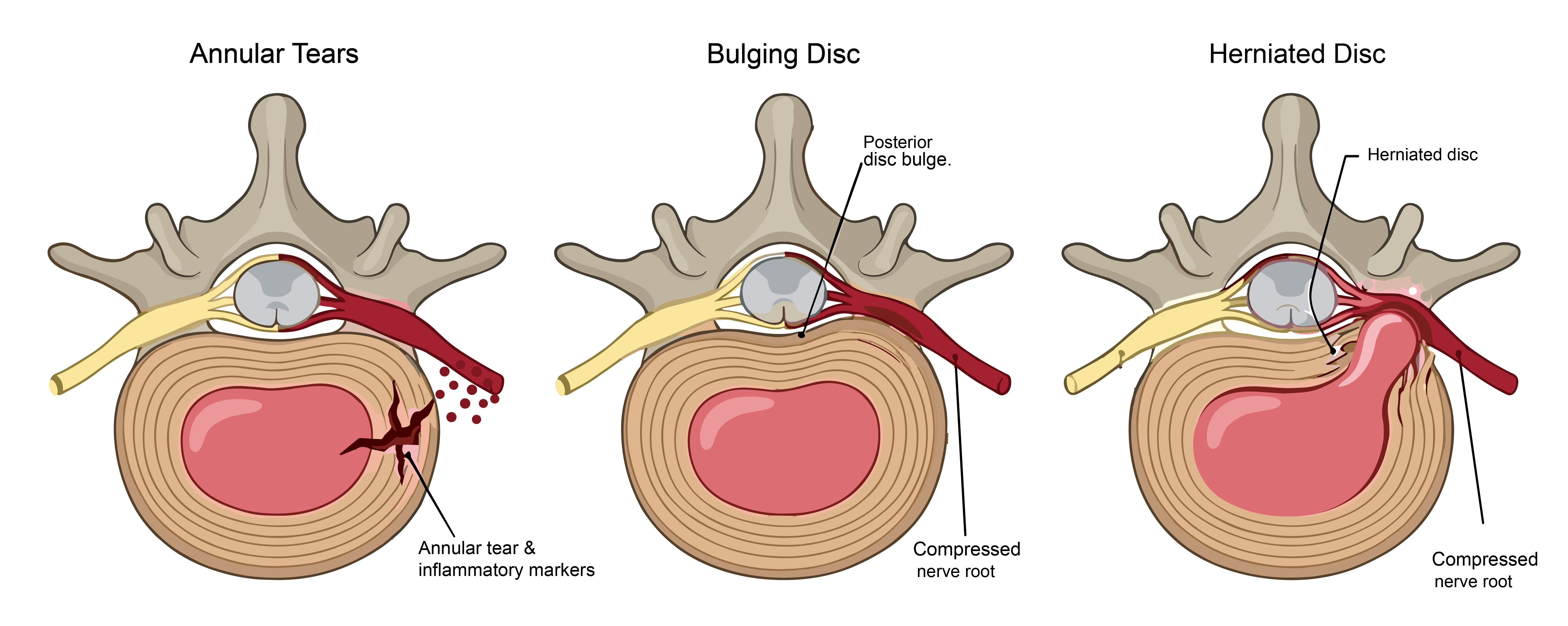 Three-panel medical diagram showing the disc damage spectrum: left panel shows an annular tear with nucleus material leaking into the tear activating inner nerve fibers causing discogenic pain; center panel shows a bulging disc with the intact annulus wall bowing outward compressing the nerve root causing radiculopathy; right panel shows a herniated disc with nucleus rupturing through the annular wall compressing and chemically irritating the nerve root causing severe radiculopathy and sciatica